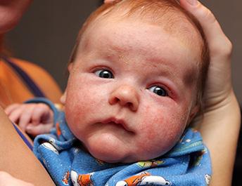 advice eczema mini